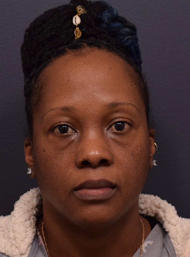 Face Before & After Gallery - Patient 63360516 - Image 1