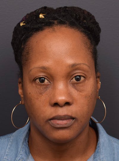 Face Before & After Gallery - Patient 63360516 - Image 2