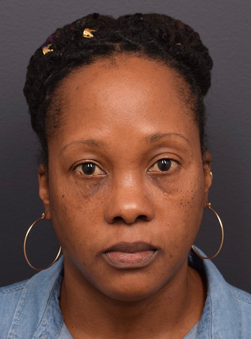 Face Before & After Gallery - Patient 63360516 - Image 2