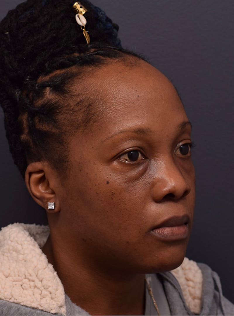 Face Before & After Gallery - Patient 63360516 - Image 3