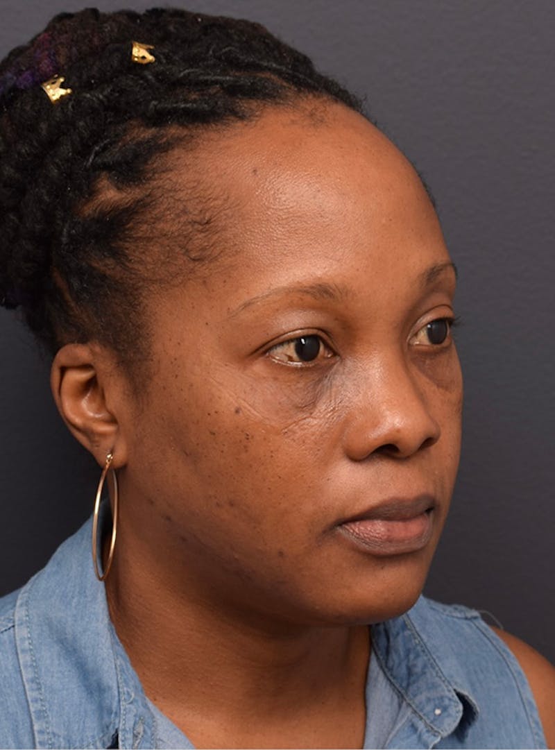 Face Before & After Gallery - Patient 63360516 - Image 4