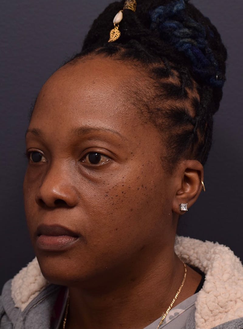 Face Before & After Gallery - Patient 63360516 - Image 5