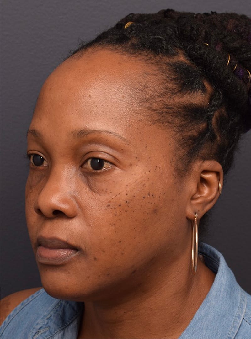 Face Before & After Gallery - Patient 63360516 - Image 6