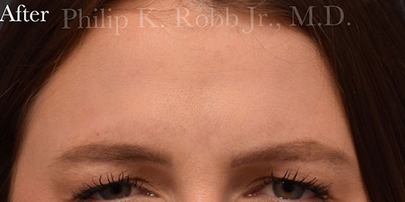 Non-Surgical Before & After Gallery - Patient 63360518 - Image 2