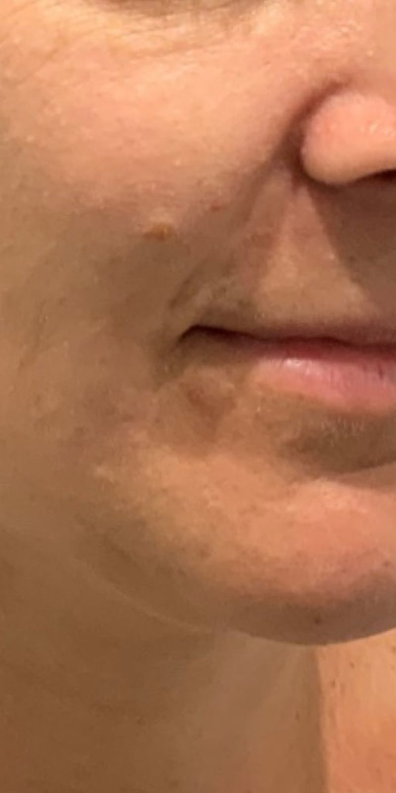 Face Before & After Gallery - Patient 63360517 - Image 2