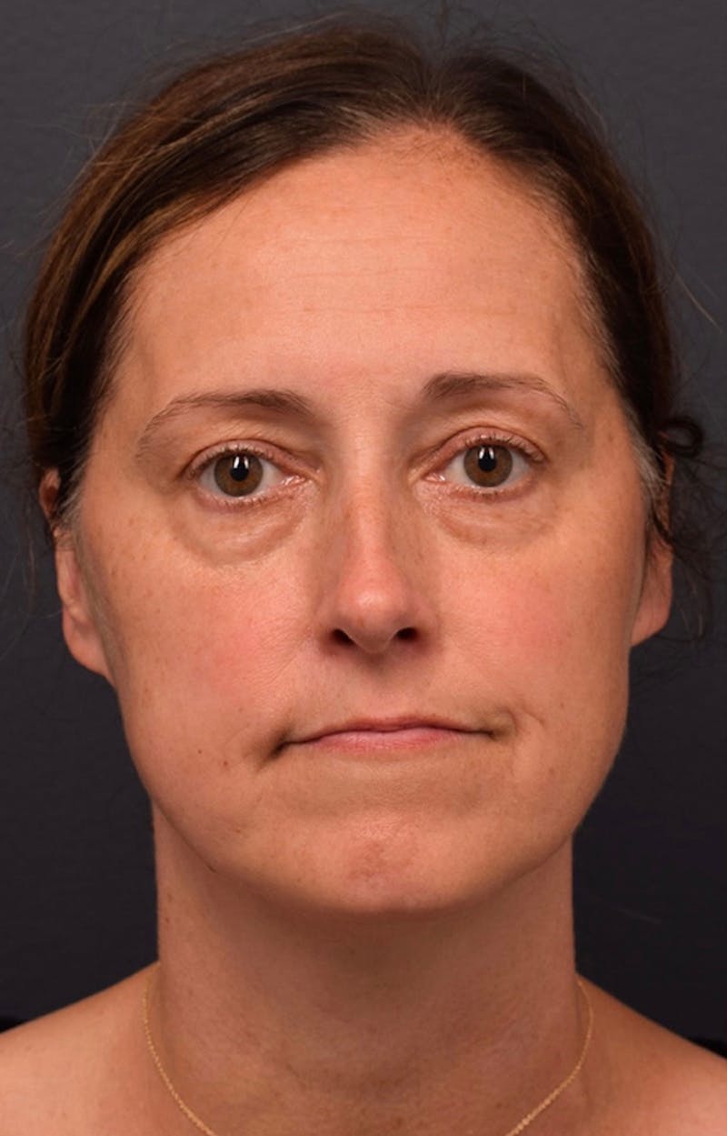 Face Before & After Gallery - Patient 63360523 - Image 1