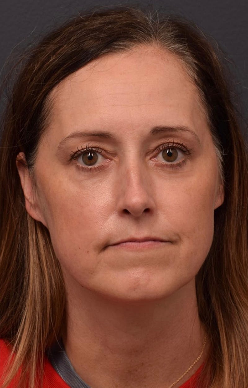 Face Before & After Gallery - Patient 63360523 - Image 2