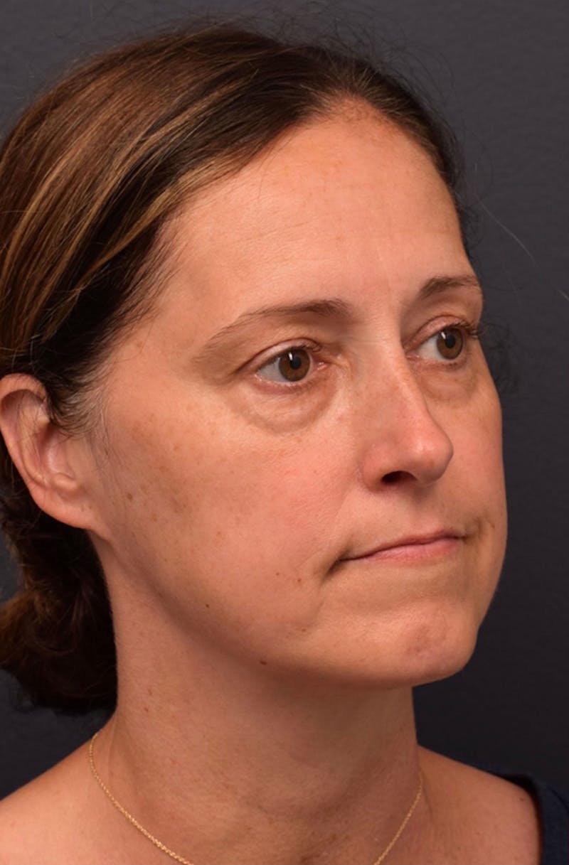Face Before & After Gallery - Patient 63360523 - Image 3