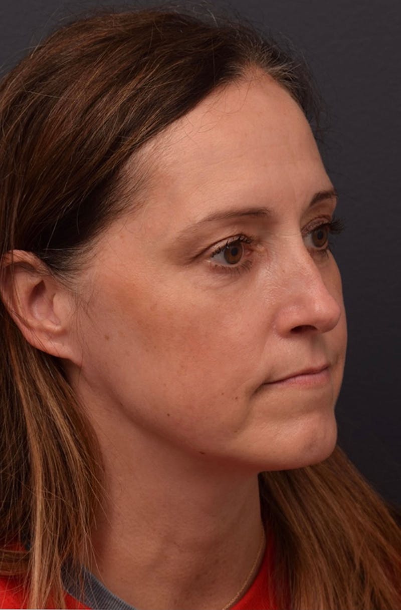 Face Before & After Gallery - Patient 63360523 - Image 4