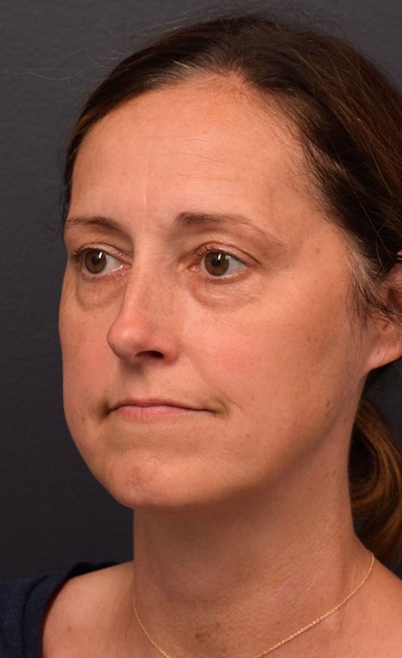 Face Before & After Gallery - Patient 63360523 - Image 5