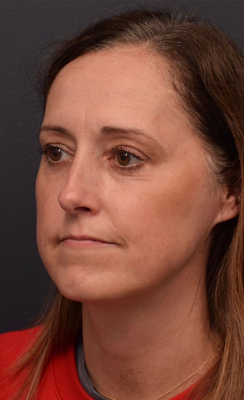 Face Before & After Gallery - Patient 63360523 - Image 6