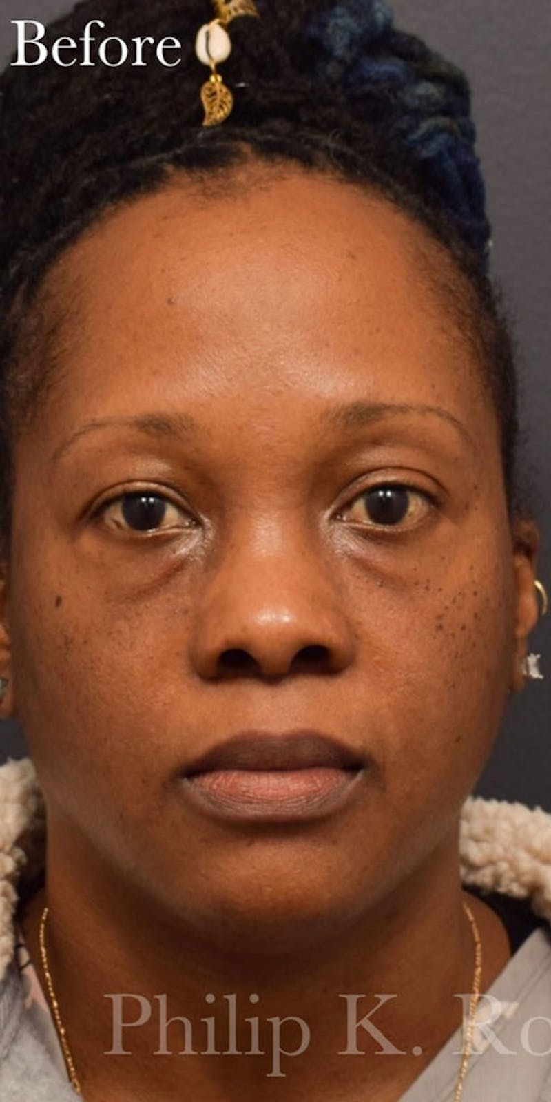 Face Before & After Gallery - Patient 63360526 - Image 1