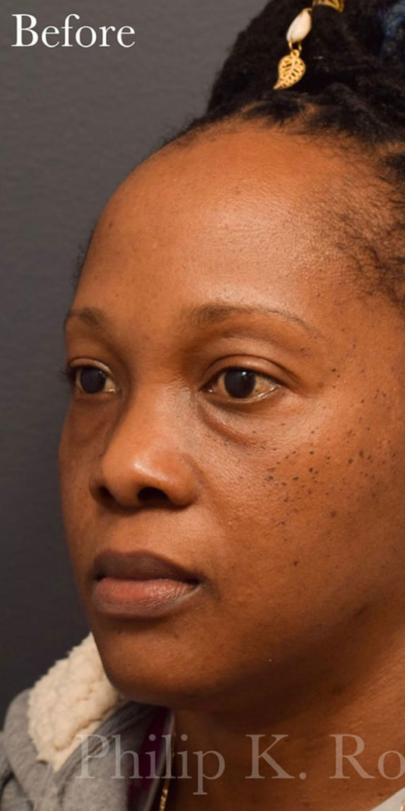 Face Before & After Gallery - Patient 63360526 - Image 3