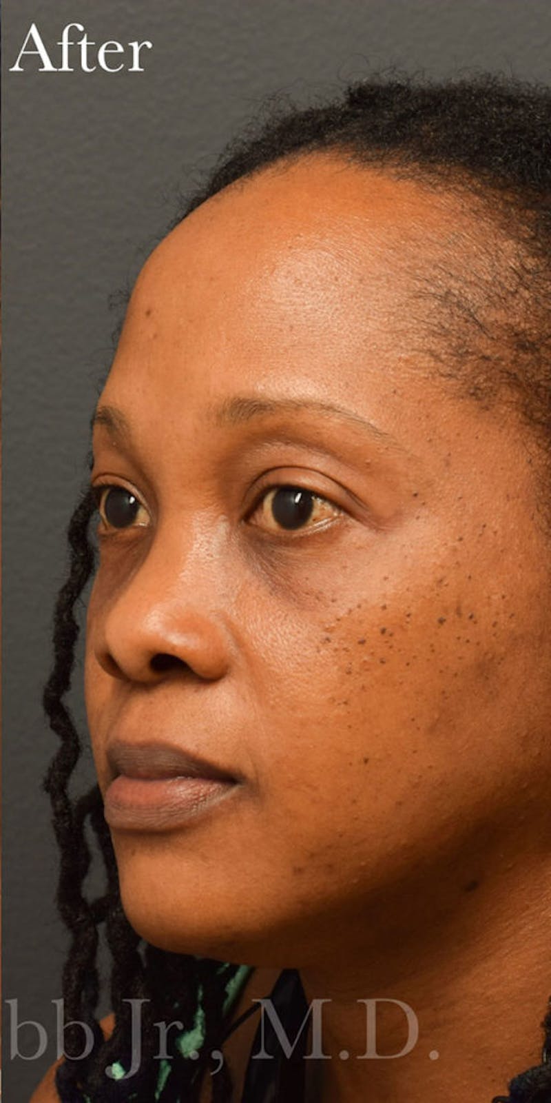 Face Before & After Gallery - Patient 63360526 - Image 4