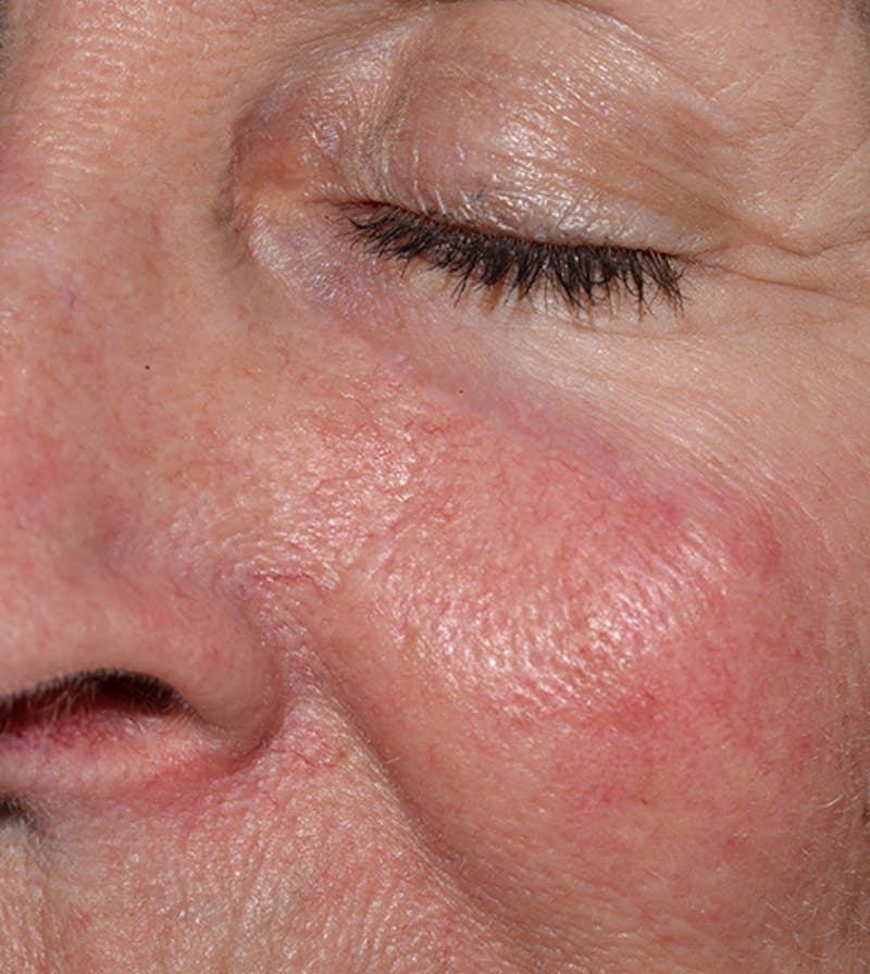 Facial Reconstruction Before & After Gallery - Patient 63360527 - Image 4