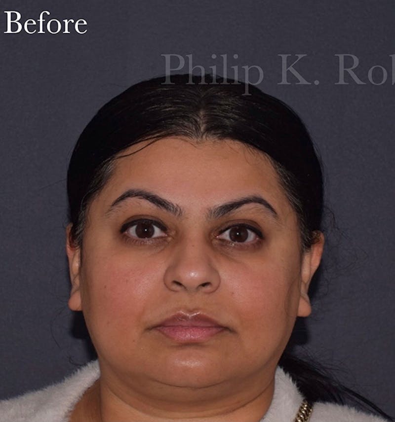 Face Before & After Gallery - Patient 63360536 - Image 1