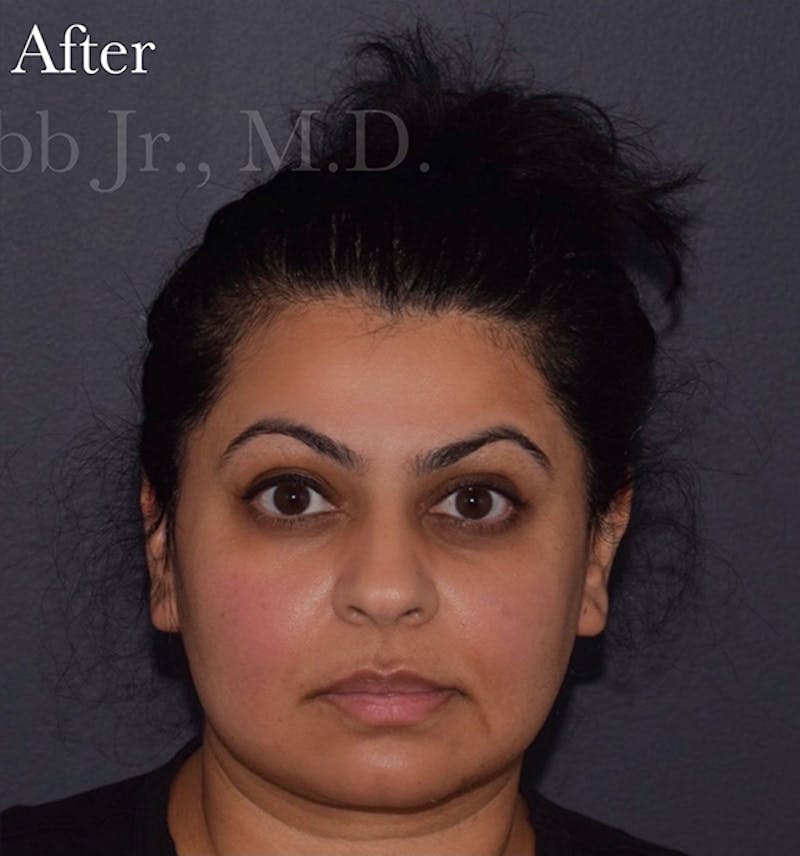 Cosmetic Surgical Before & After Gallery - Patient 63360536 - Image 2