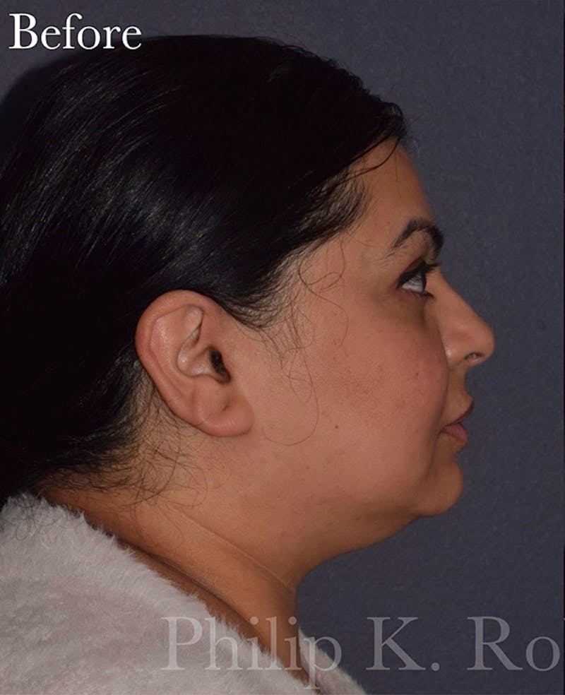Face Before & After Gallery - Patient 63360536 - Image 3