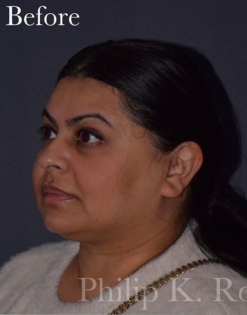 Face Before & After Gallery - Patient 63360536 - Image 7