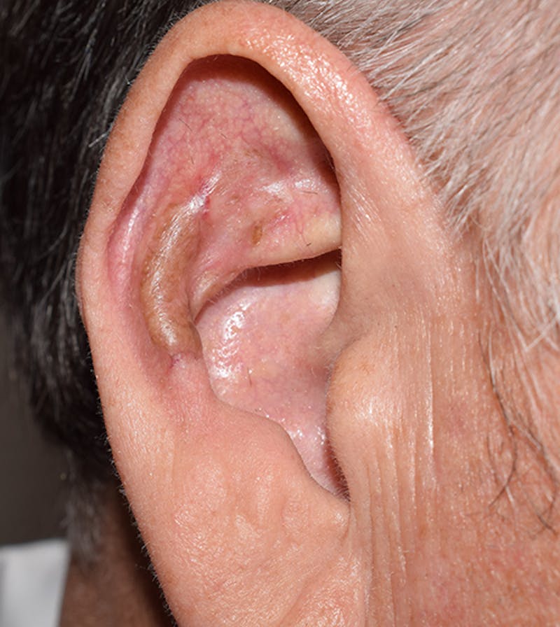 Facial Reconstruction Before & After Gallery - Patient 63360532 - Image 4