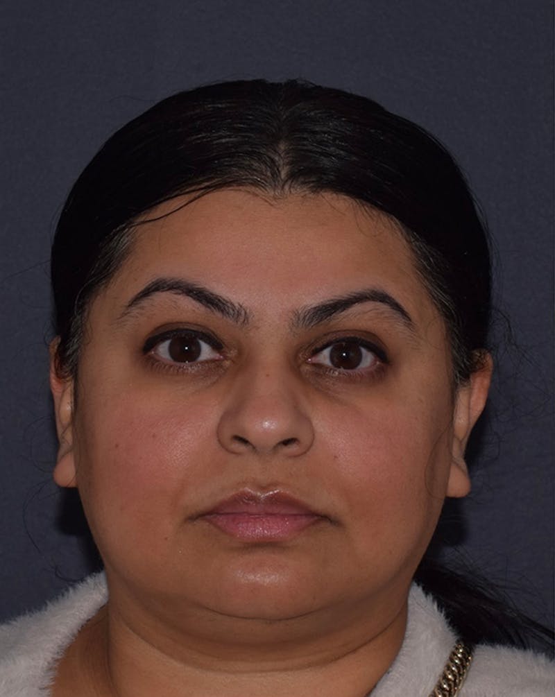 Face Before & After Gallery - Patient 63360536 - Image 11