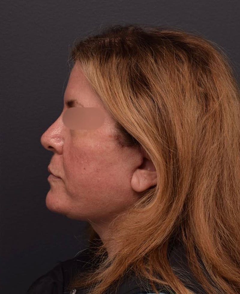 Cosmetic Non-Surgical Before & After Gallery - Patient 63360537 - Image 10