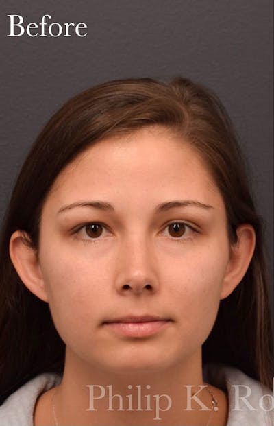 Face Before & After Gallery - Patient 63360539 - Image 1