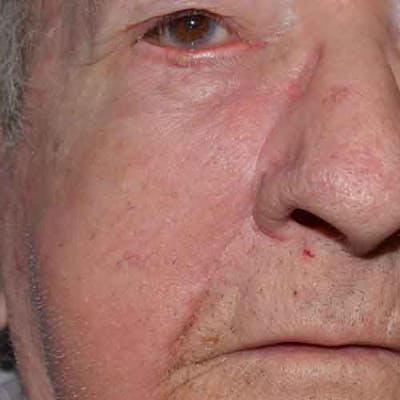 Facial Reconstruction Before & After Gallery - Patient 63360538 - Image 2