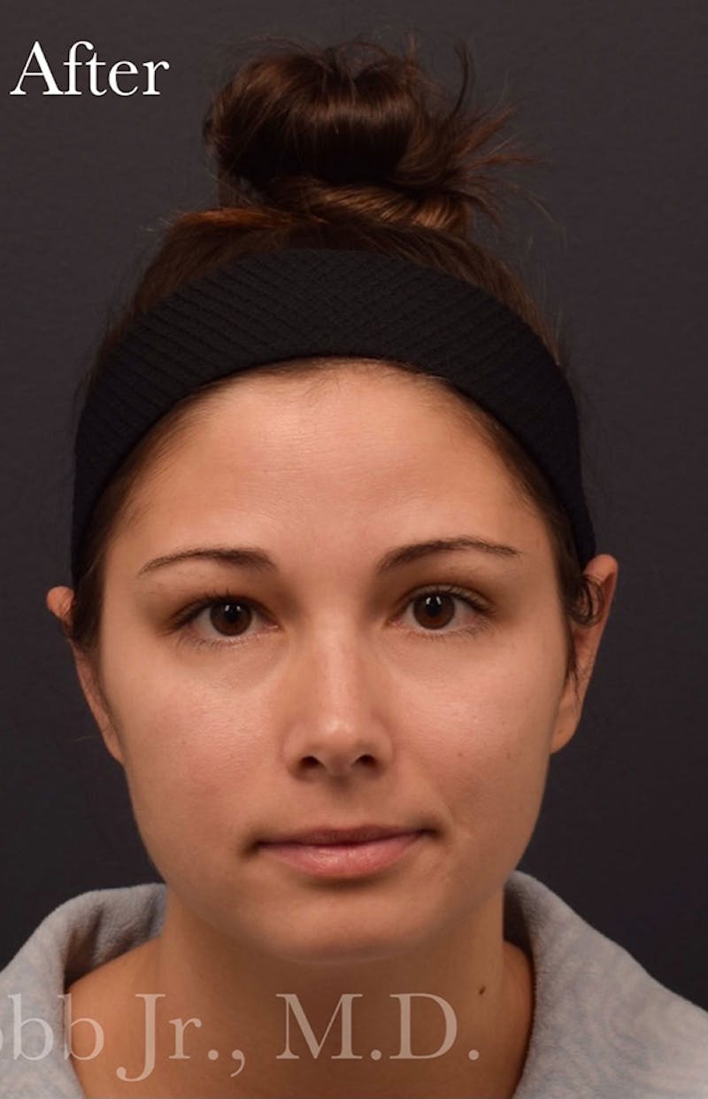 Face Before & After Gallery - Patient 63360539 - Image 2