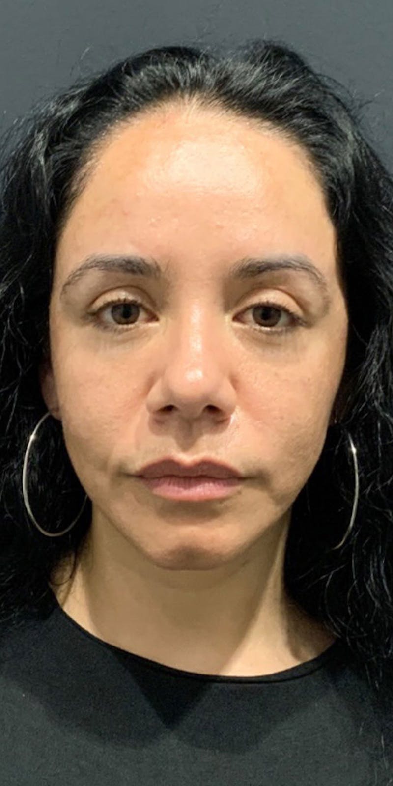 Face Before & After Gallery - Patient 63360543 - Image 1