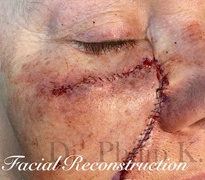 Facial Reconstruction Before & After Gallery - Patient 63360541 - Image 2