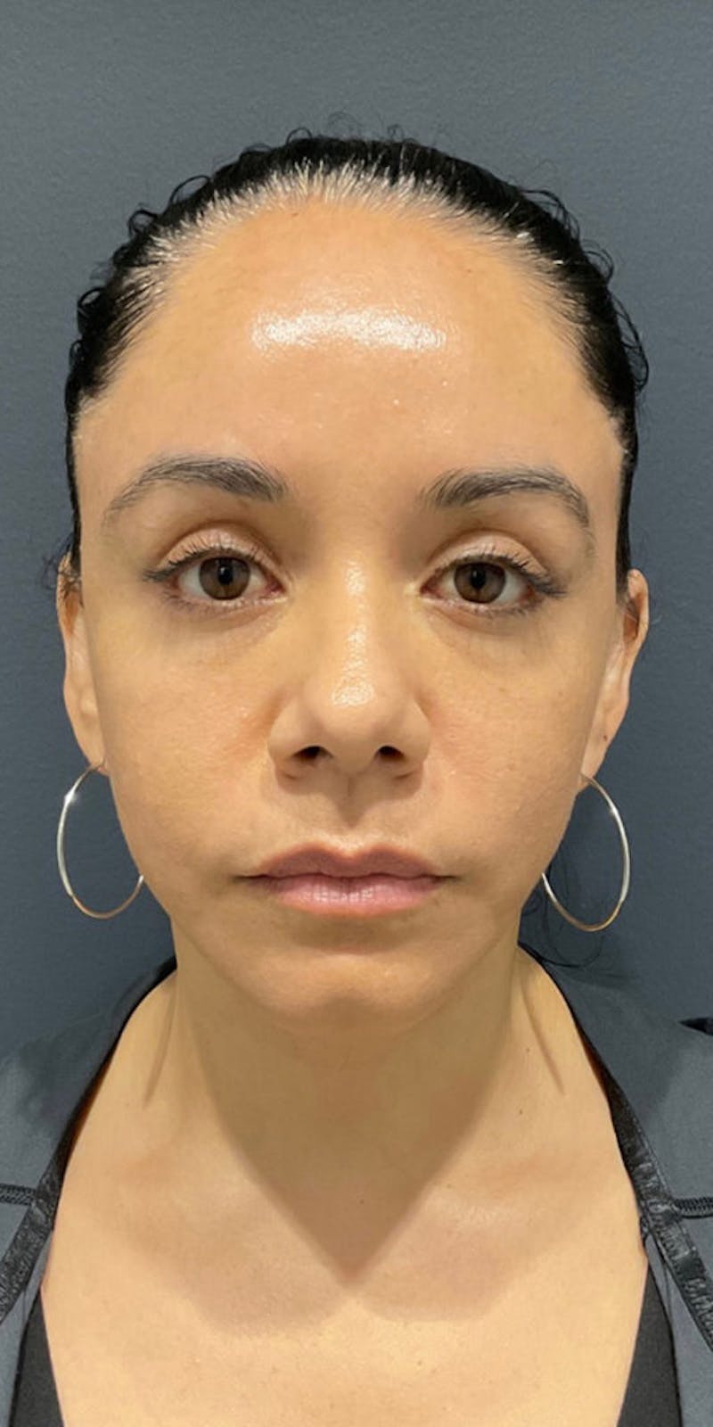 Face Before & After Gallery - Patient 63360543 - Image 2