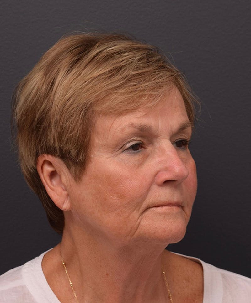 Non-Surgical Before & After Gallery - Patient 63360546 - Image 3