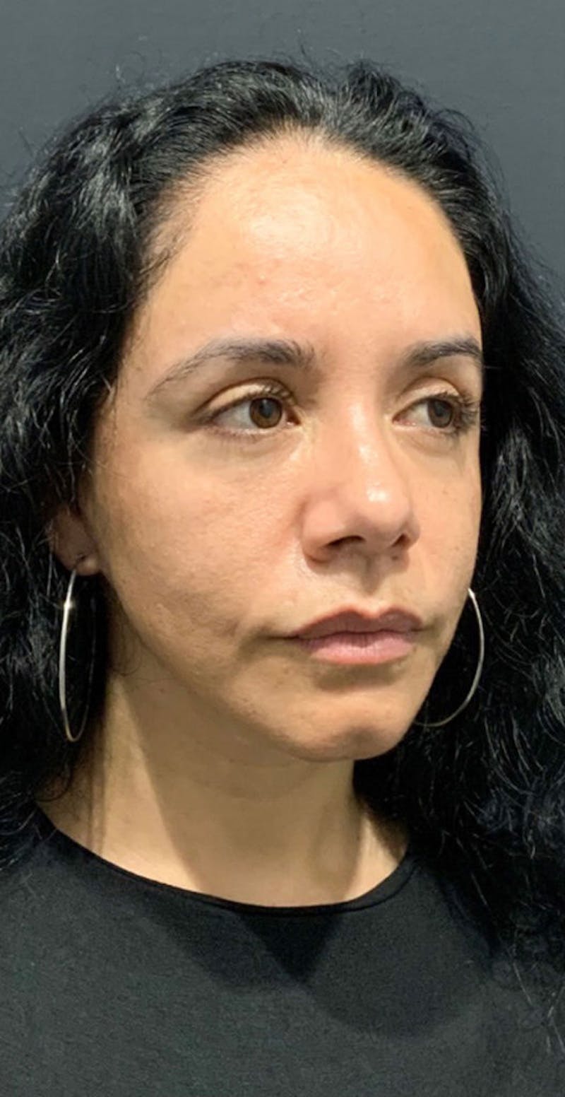 Face Before & After Gallery - Patient 63360543 - Image 3