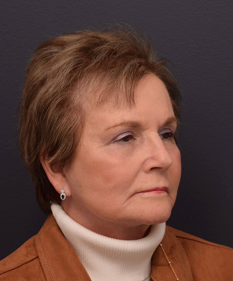 Non-Surgical Before & After Gallery - Patient 63360546 - Image 4