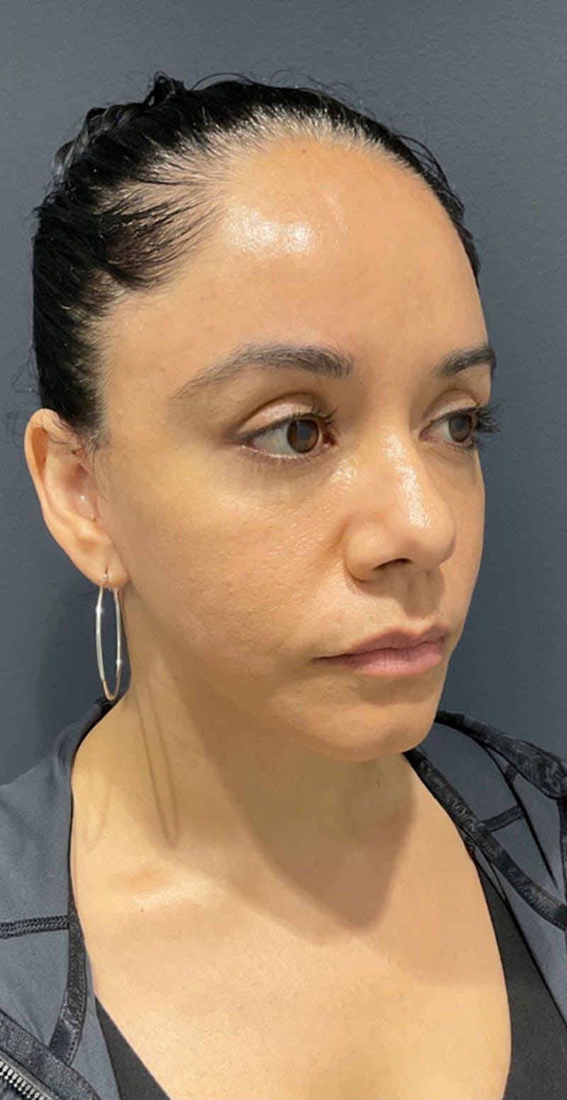 Face Before & After Gallery - Patient 63360543 - Image 4