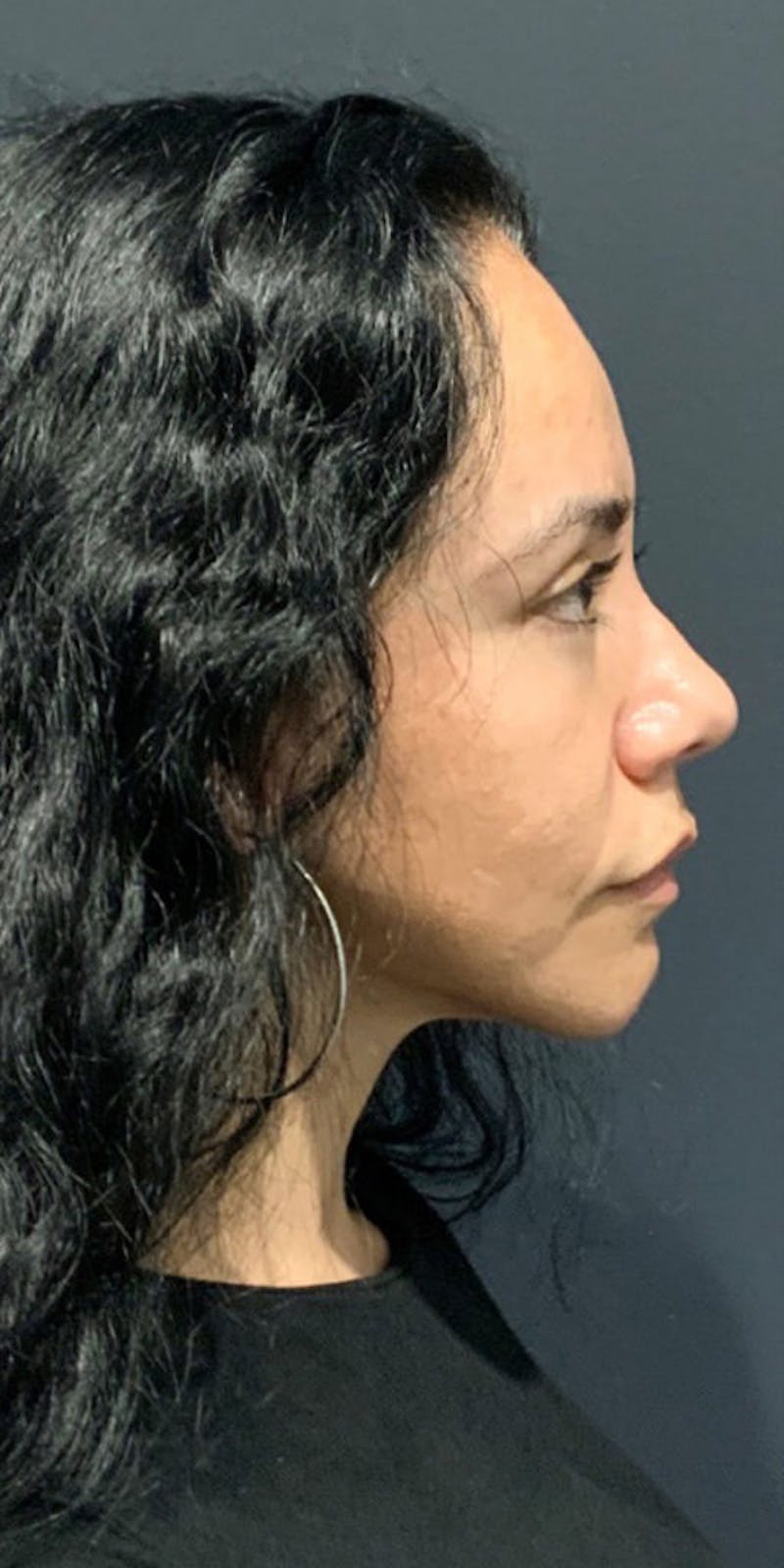 Face Before & After Gallery - Patient 63360543 - Image 5