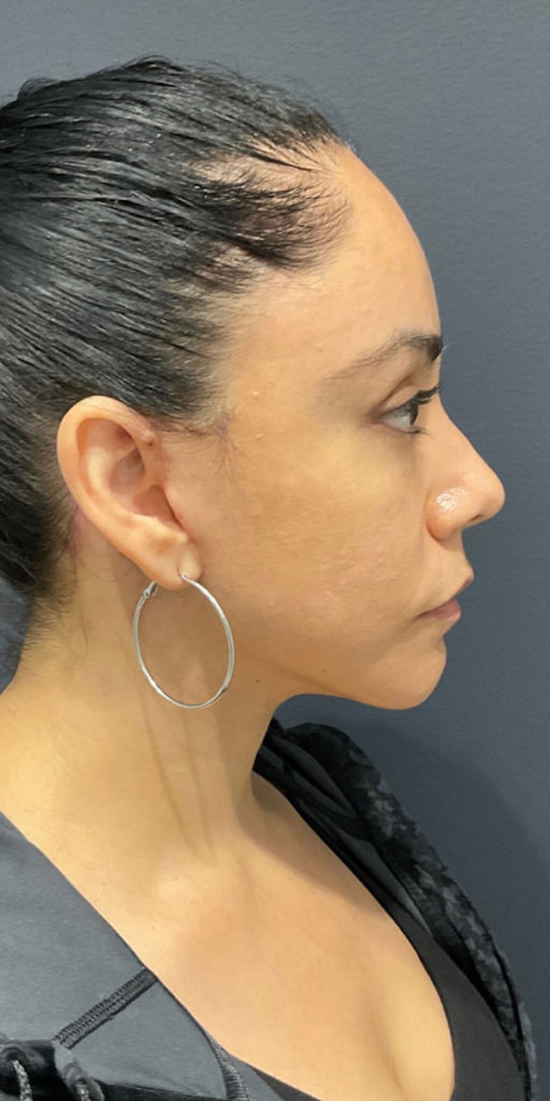 Face Before & After Gallery - Patient 63360543 - Image 6