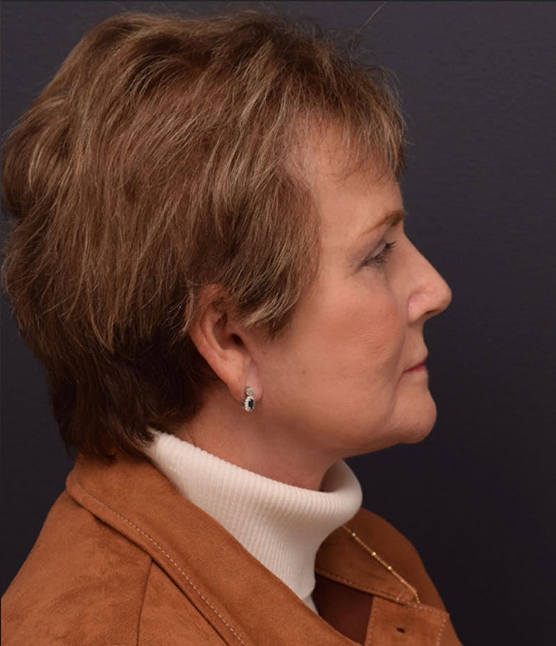 Non-Surgical Before & After Gallery - Patient 63360546 - Image 6