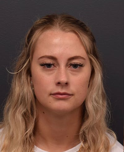 Face Before & After Gallery - Patient 63360549 - Image 1