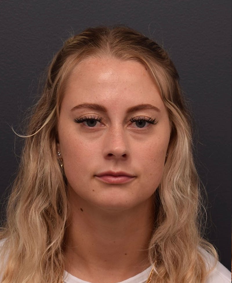 Face Before & After Gallery - Patient 63360549 - Image 1