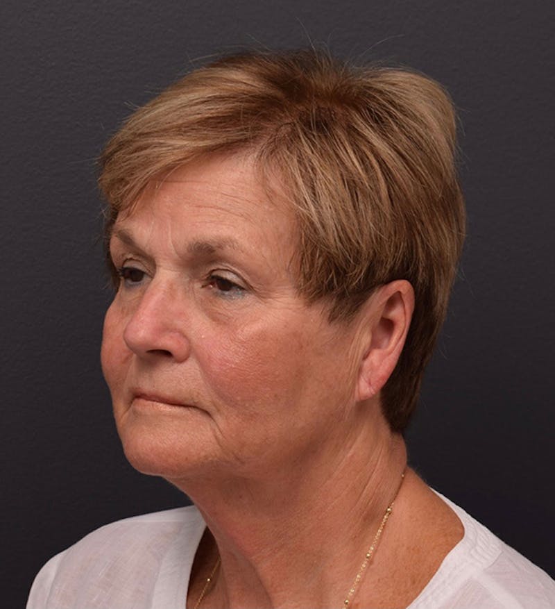 Non-Surgical Before & After Gallery - Patient 63360546 - Image 7