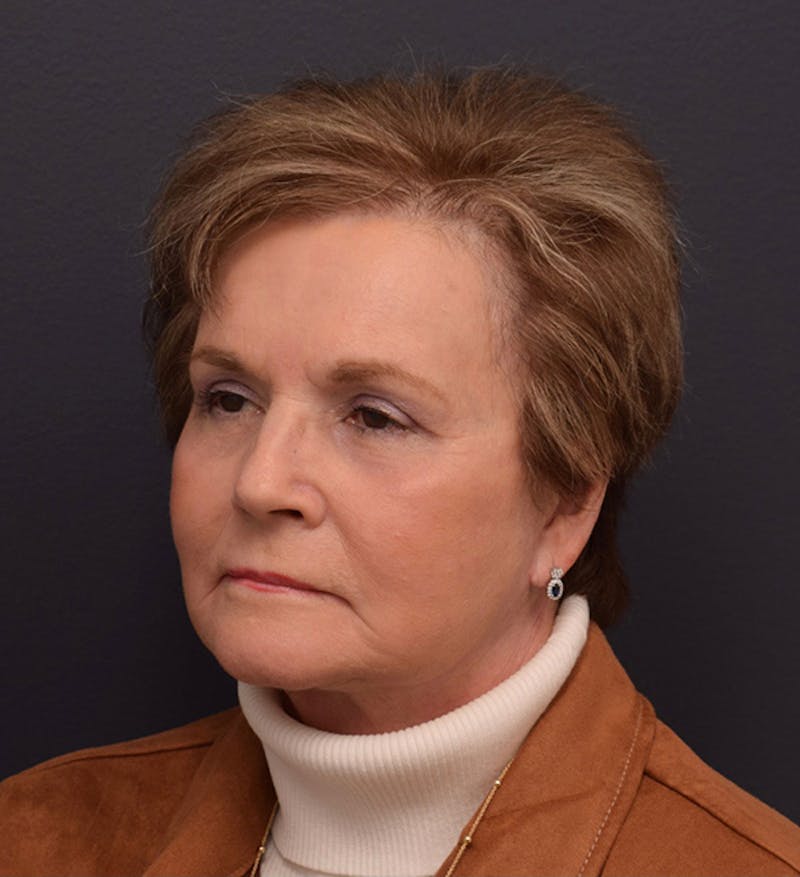 Non-Surgical Before & After Gallery - Patient 63360546 - Image 8
