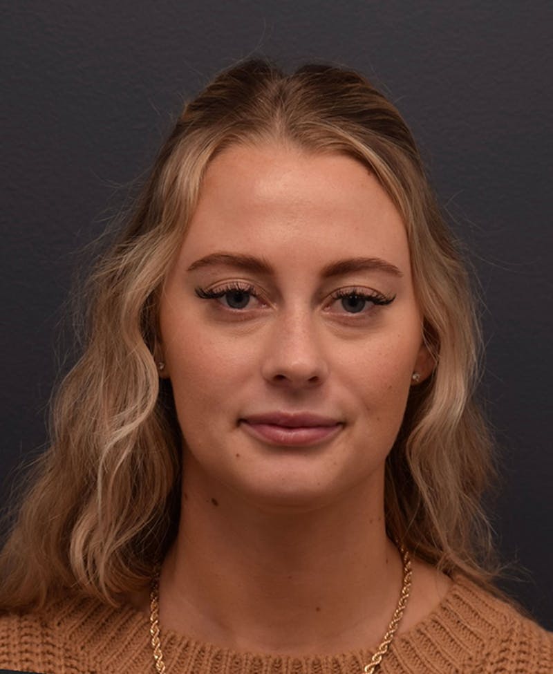Face Before & After Gallery - Patient 63360549 - Image 2
