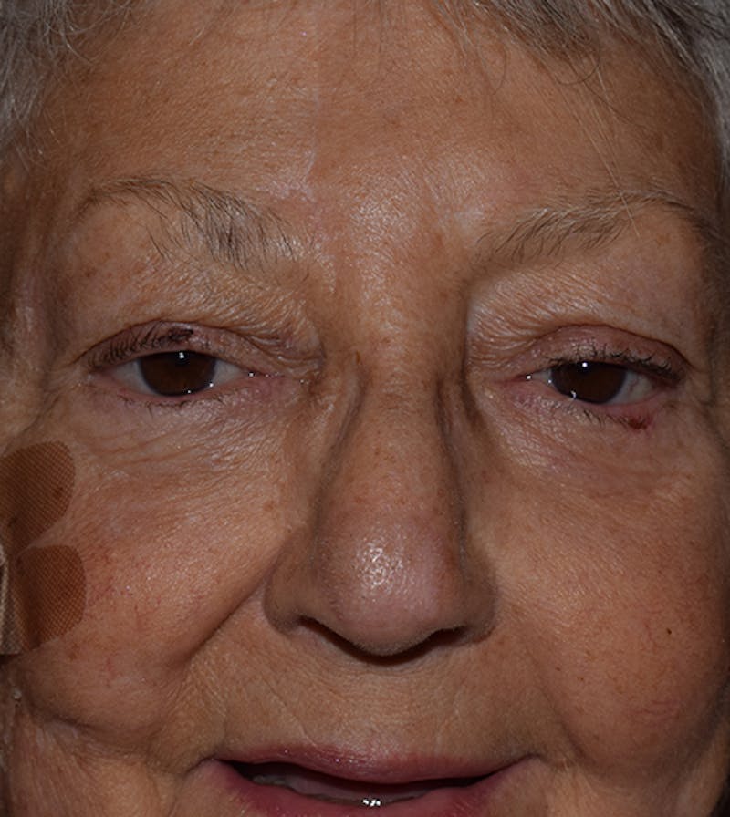 Facial Reconstruction Before & After Gallery - Patient 63360545 - Image 2