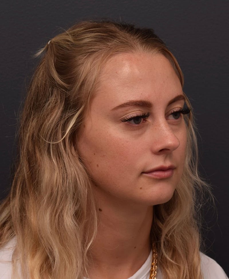 Face Before & After Gallery - Patient 63360549 - Image 3
