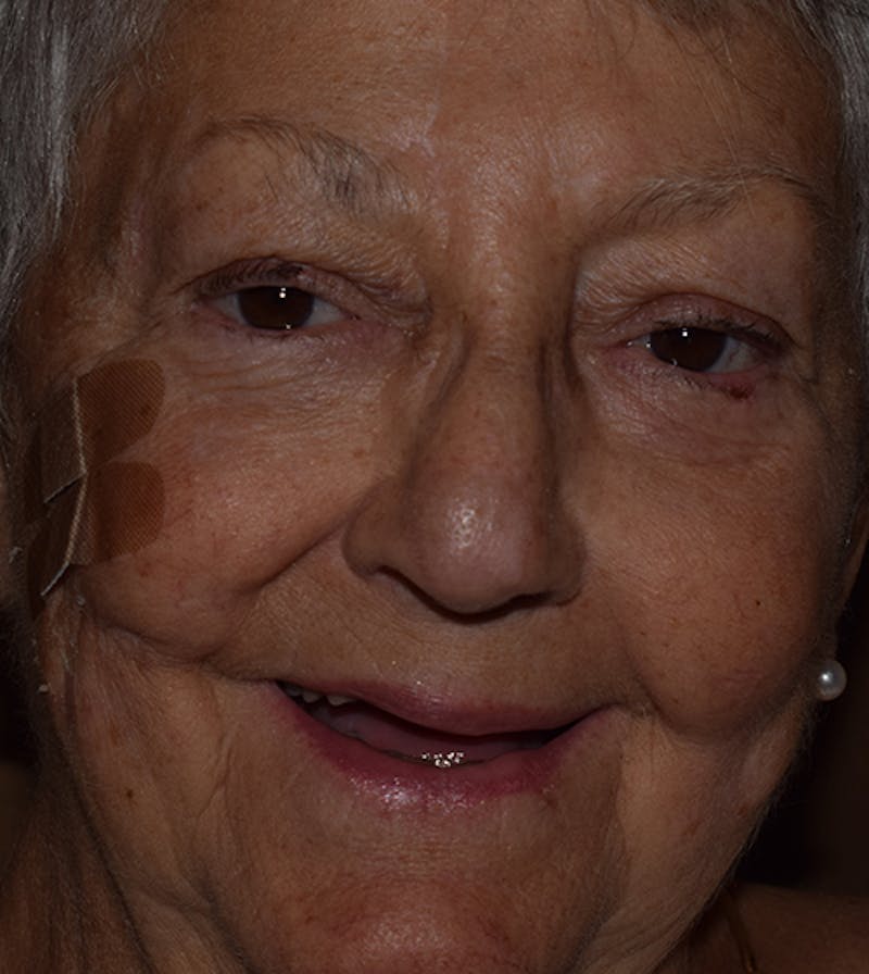 Facial Reconstruction Before & After Gallery - Patient 63360545 - Image 4