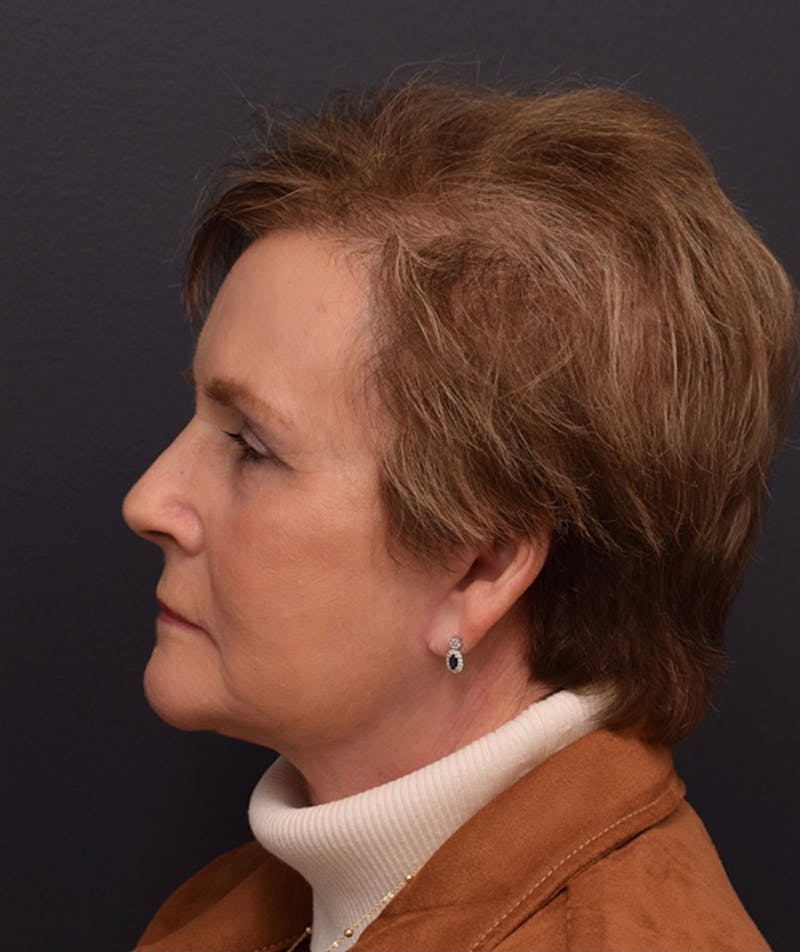 Non-Surgical Before & After Gallery - Patient 63360546 - Image 10