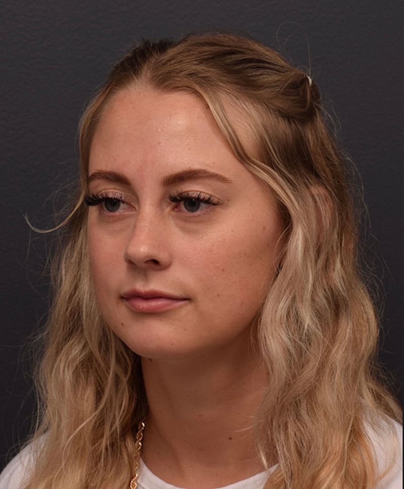 Face Before & After Gallery - Patient 63360549 - Image 5