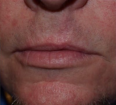 Facial Reconstruction Before & After Gallery - Patient 63360547 - Image 2